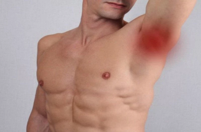 Βρήκατε «γρομπαλάκι» στην μασχάλη; Τι μπορεί να είναι και πότε πρέπει να ανησυχήσετε!